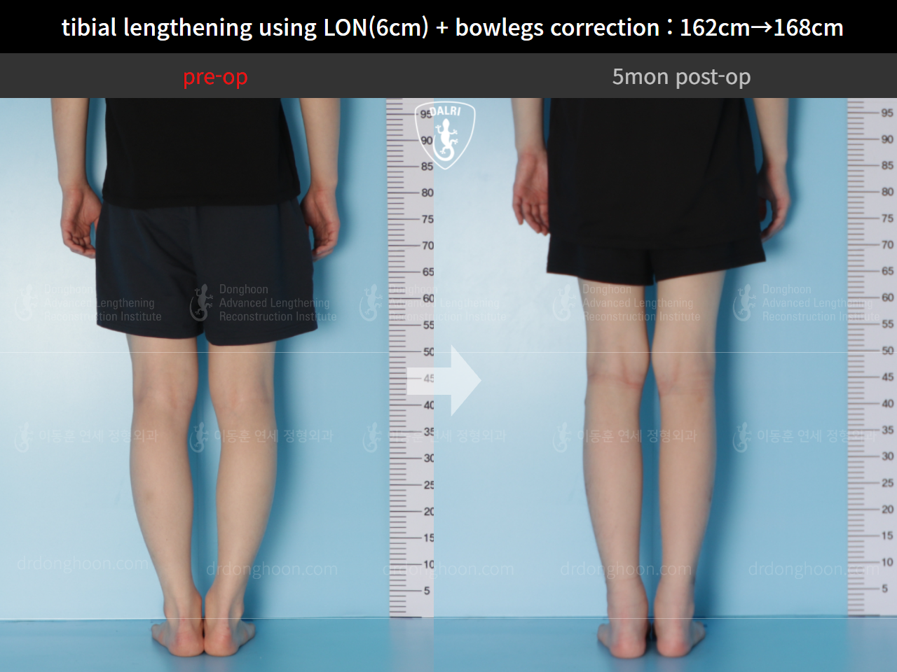 Before and after cll + deformity correction, case 5316038, image 4, Dr. Donghoon institute (DALRI)