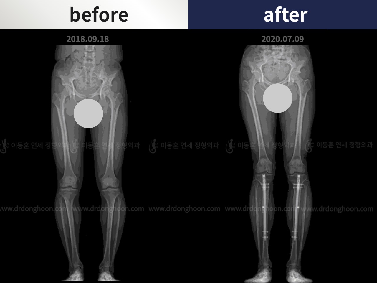 Before and after cll + deformity correction, case 4585674, image 3, Dr. Donghoon institute (DALRI)