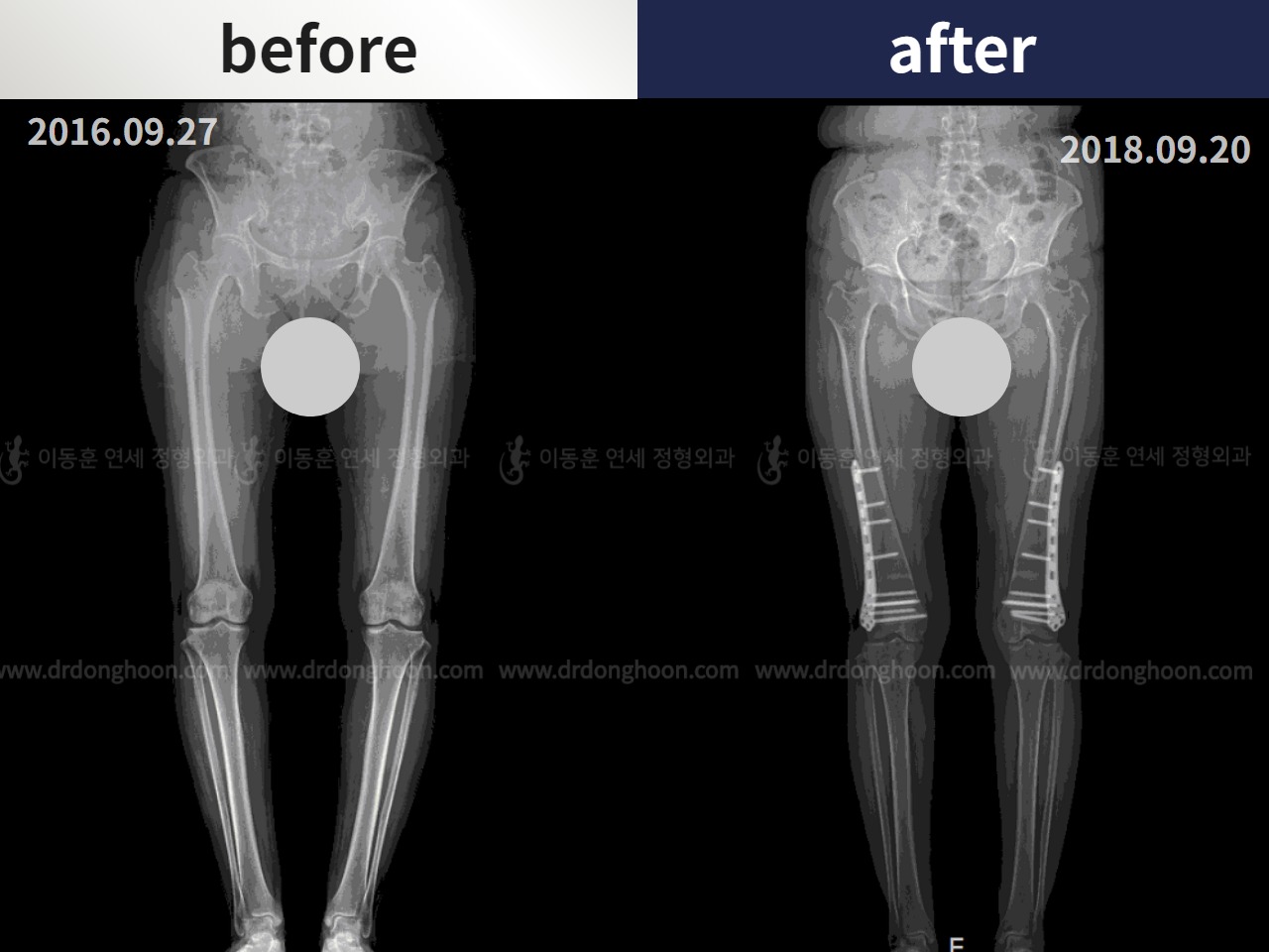 Before and after osteotomy for knee osteoarthritis, case 4306421, image 3, Dr. Donghoon institute (DALRI)
