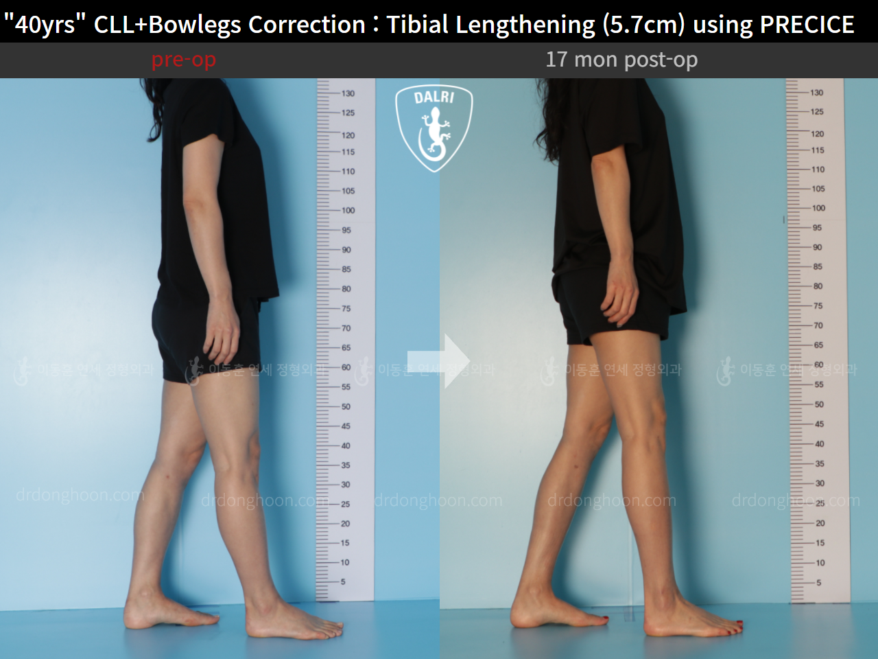 Before and after cll precice, case 9180903, image 3, Dr. Donghoon institute (DALRI)