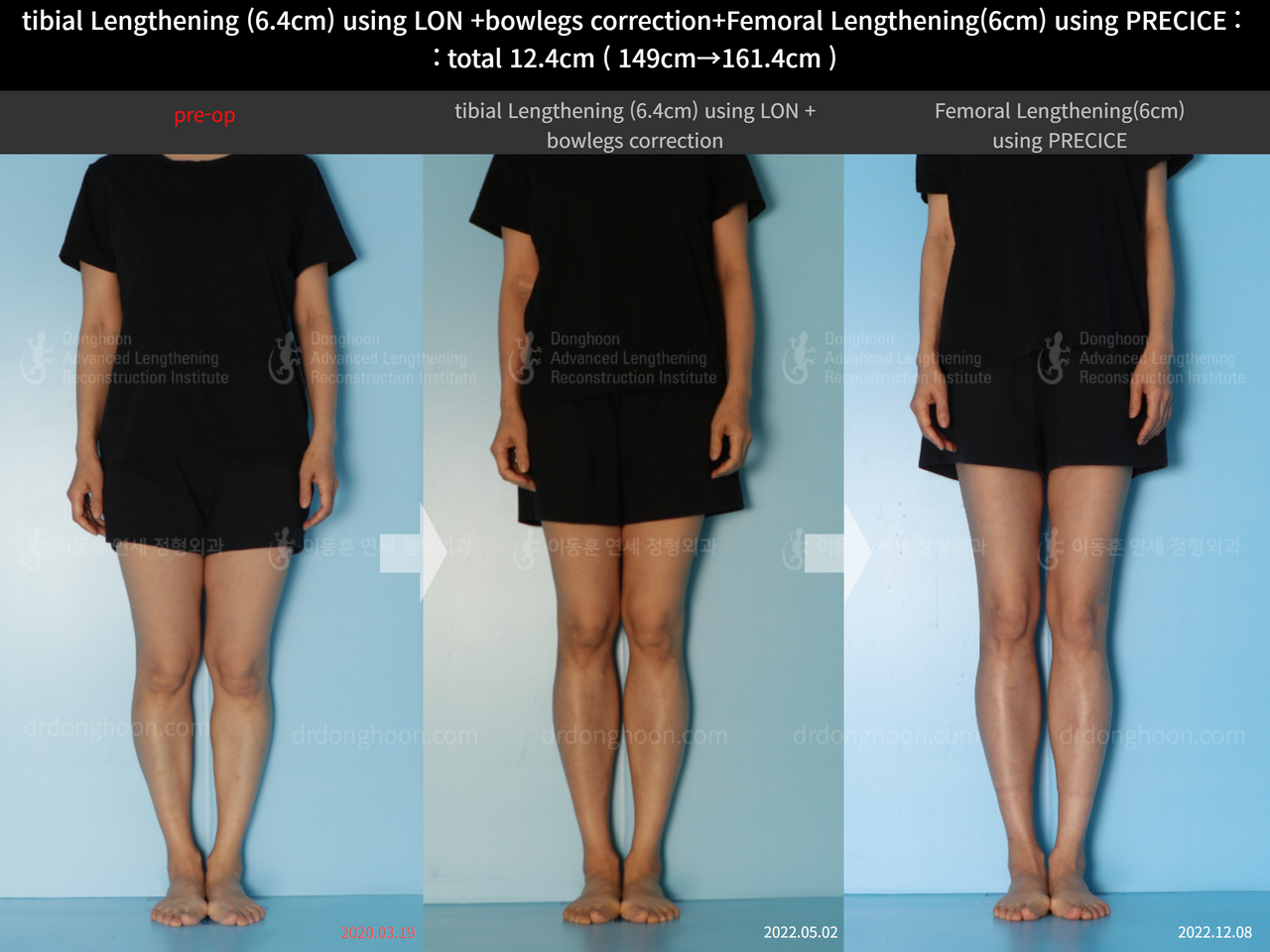 Before and after cll precice, case 13696246, image 1, Dr. Donghoon institute (DALRI)