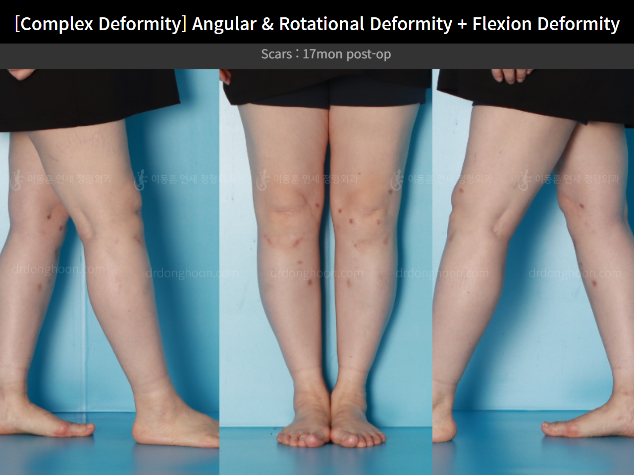 Before and after osteotomy for knee osteoarthritis, case 16781349, image 11, Dr. Donghoon institute (DALRI)