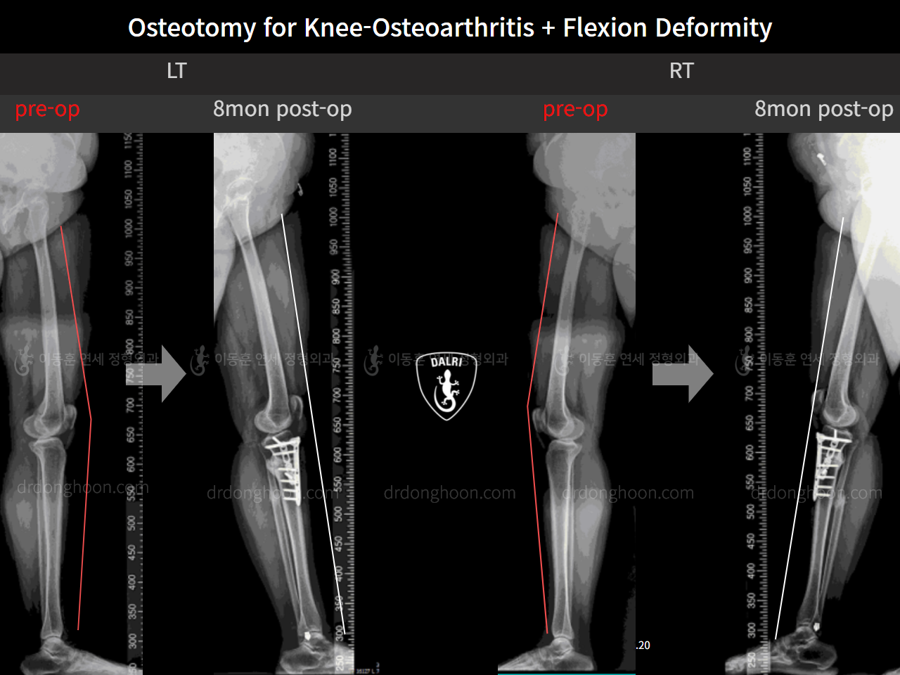 Before and after osteotomy for knee osteoarthritis, case 10663581, image 8, Dr. Donghoon institute (DALRI)
