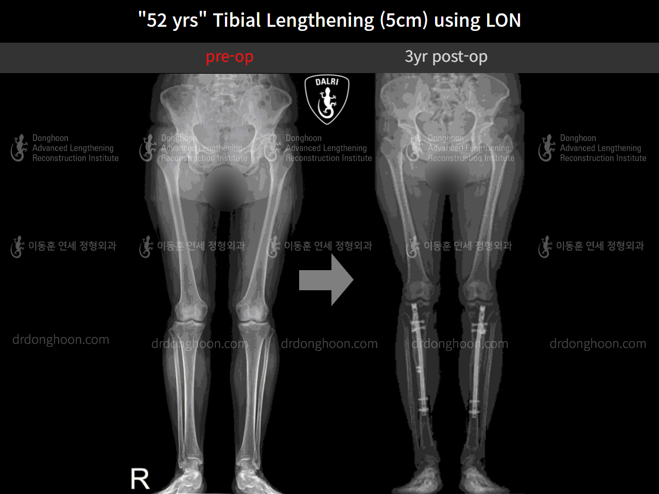 Before and after cll lon, case 9977769, image 9, Dr. Donghoon institute (DALRI)