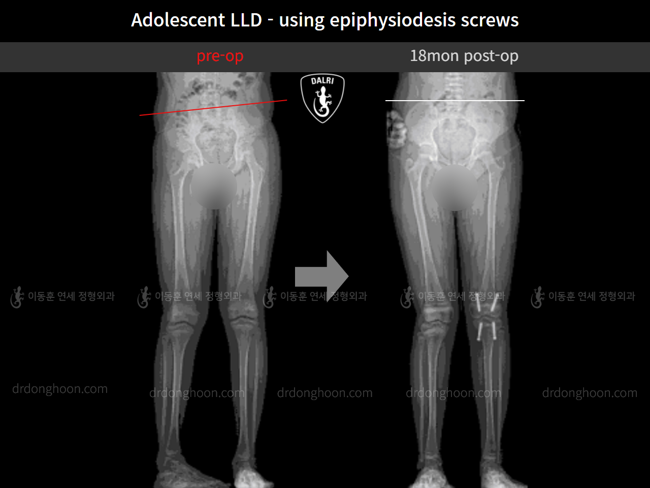 Before and after paediatric & adolescent lld, case 10439770, image 5, Dr. Donghoon institute (DALRI)