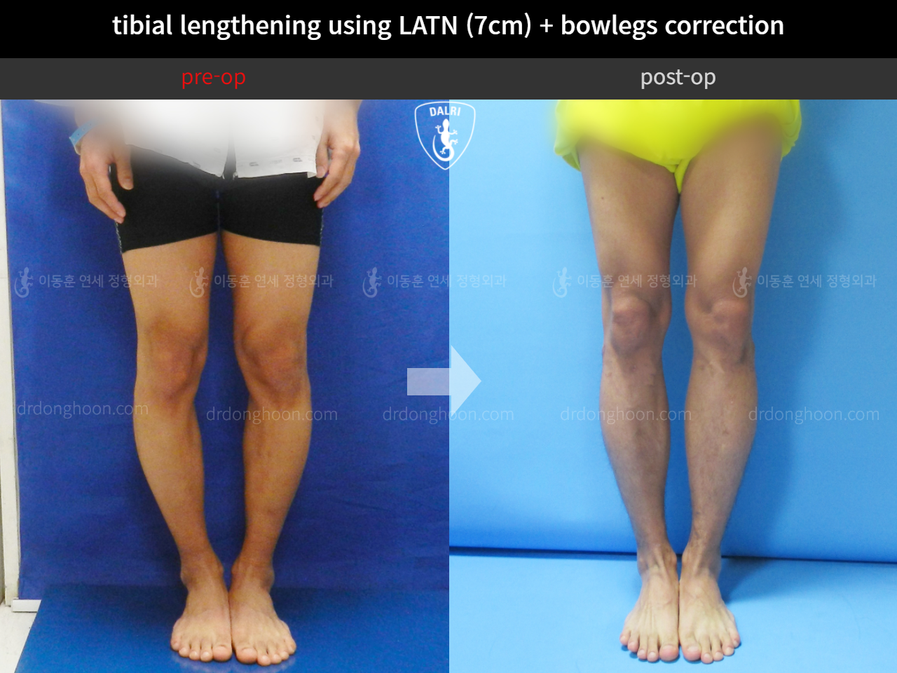 Before and after cll + deformity correction, case 4323114, image 4, Dr. Donghoon institute (DALRI)