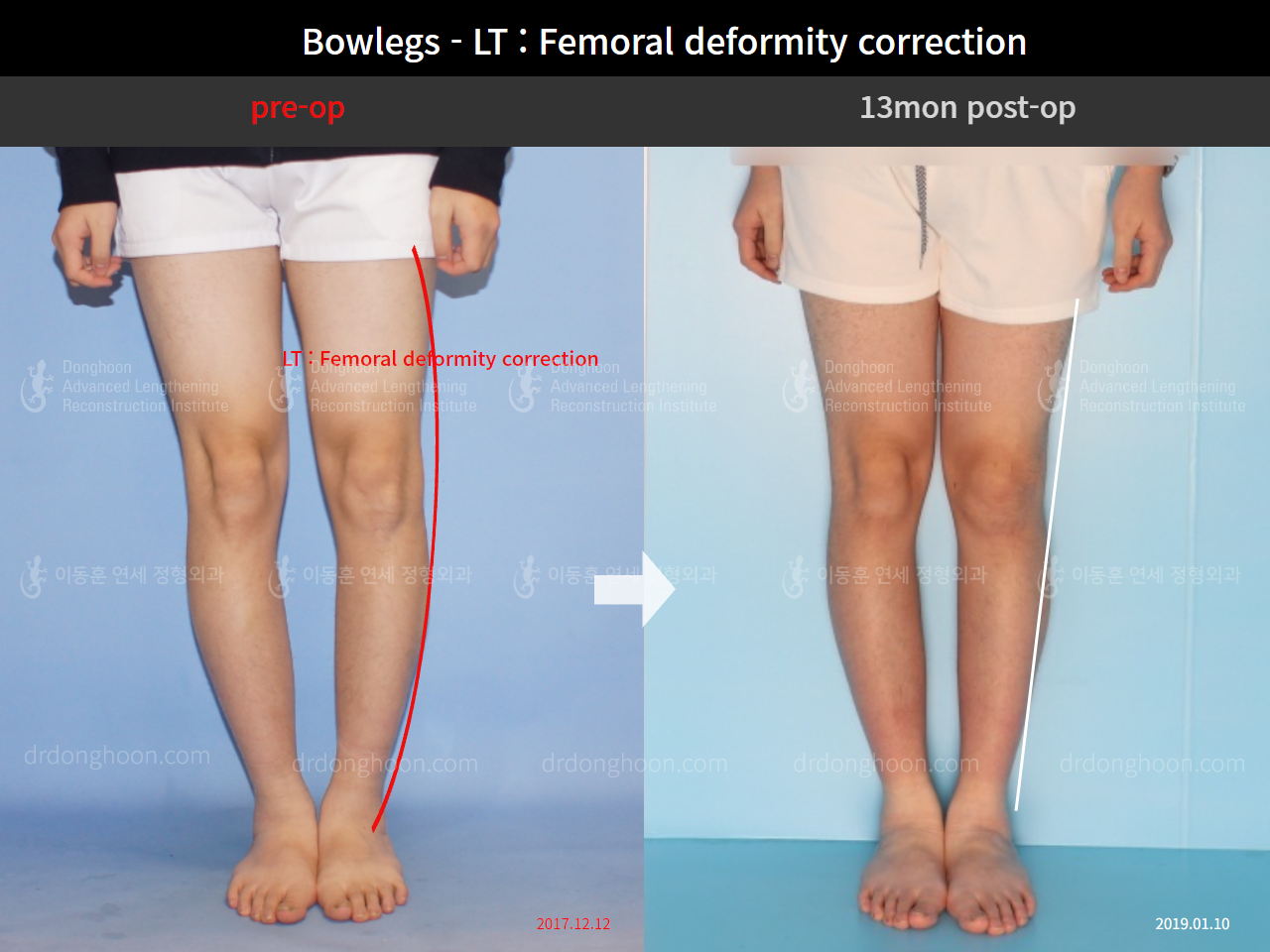 Before and after adult bowlegs, case 8932864, image 2, Dr. Donghoon institute (DALRI)