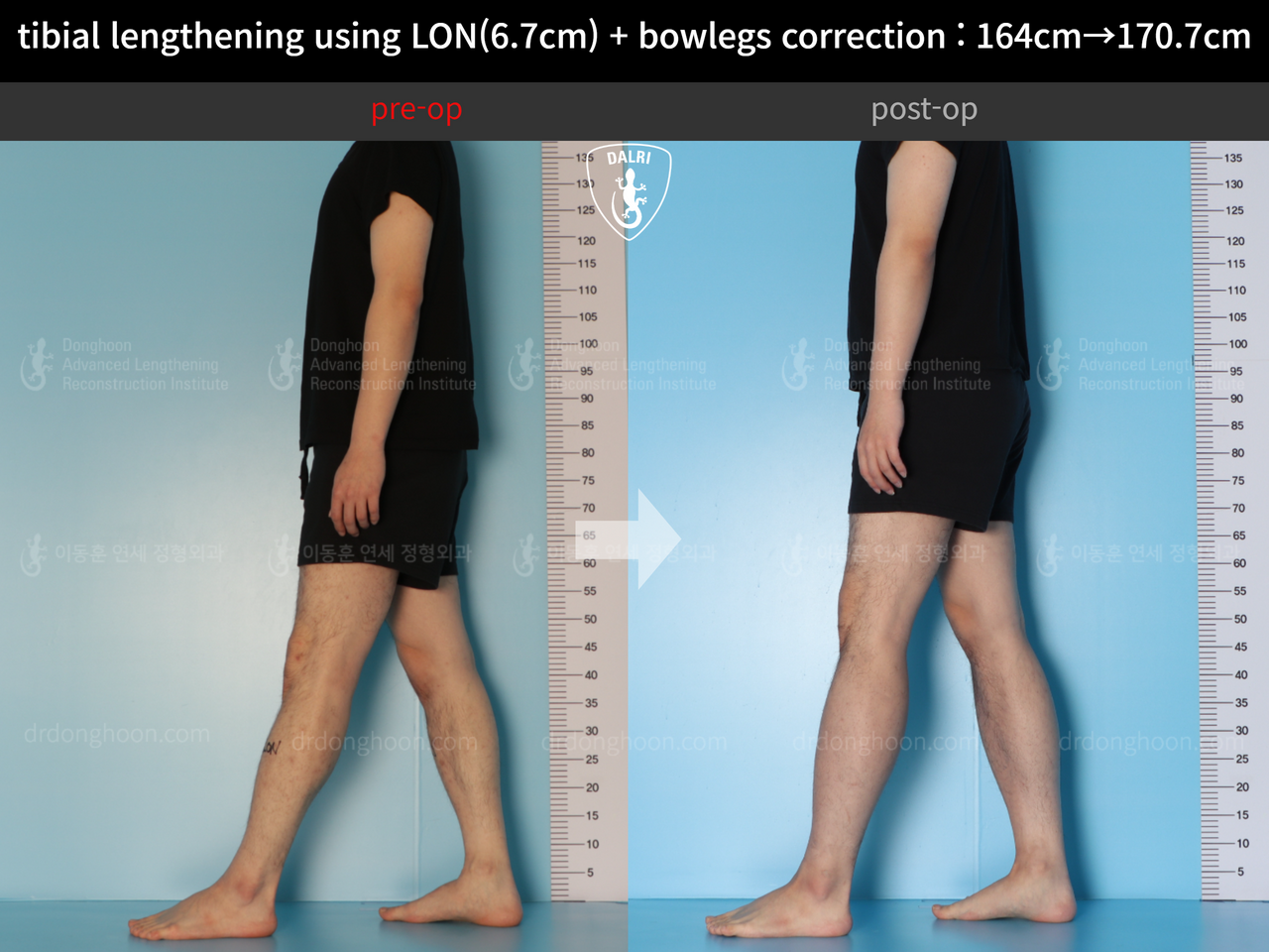 Before and after cll + deformity correction, case 13914972, image 6, Dr. Donghoon institute (DALRI)
