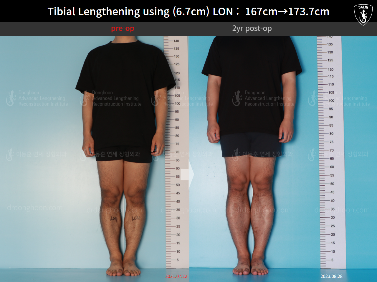 Before and after cll lon, case 16165376, image 1, Dr. Donghoon institute (DALRI)