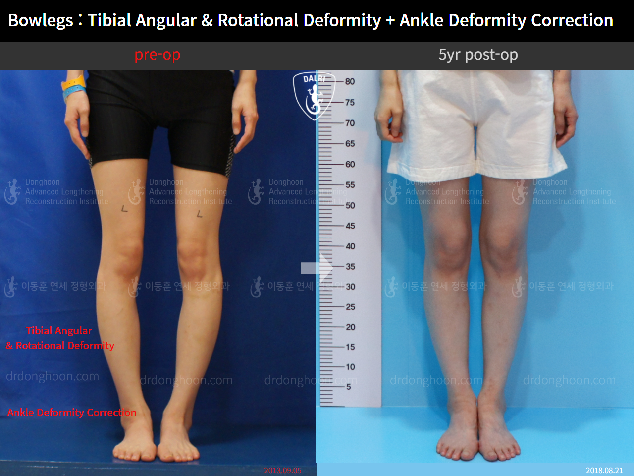 Before and after adult bowlegs, case 4311377, image 3, Dr. Donghoon institute (DALRI)