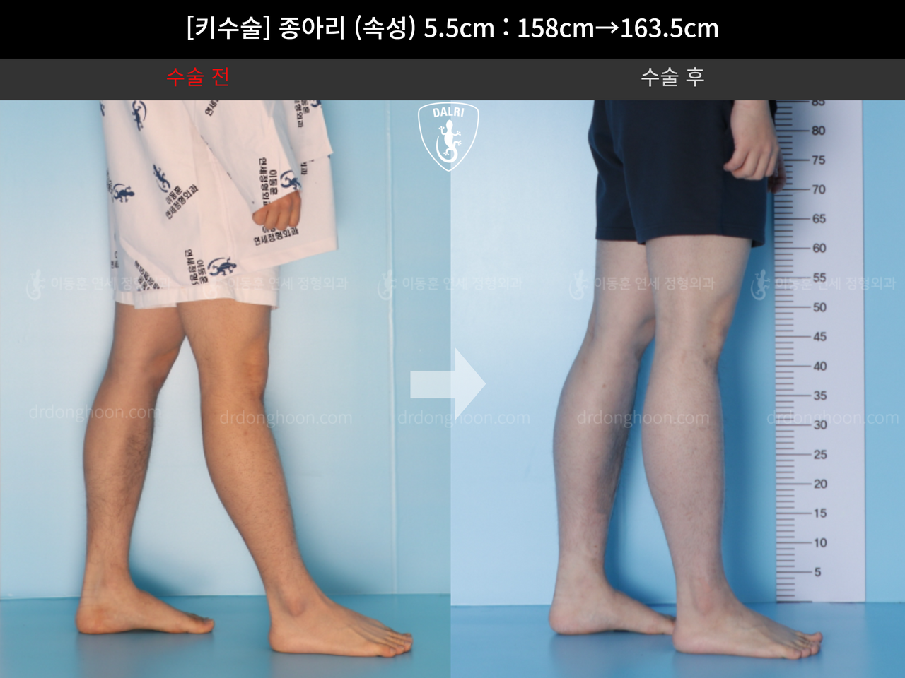 Before and after cll lon, case 4577764, image 7, Dr. Donghoon institute (DALRI)