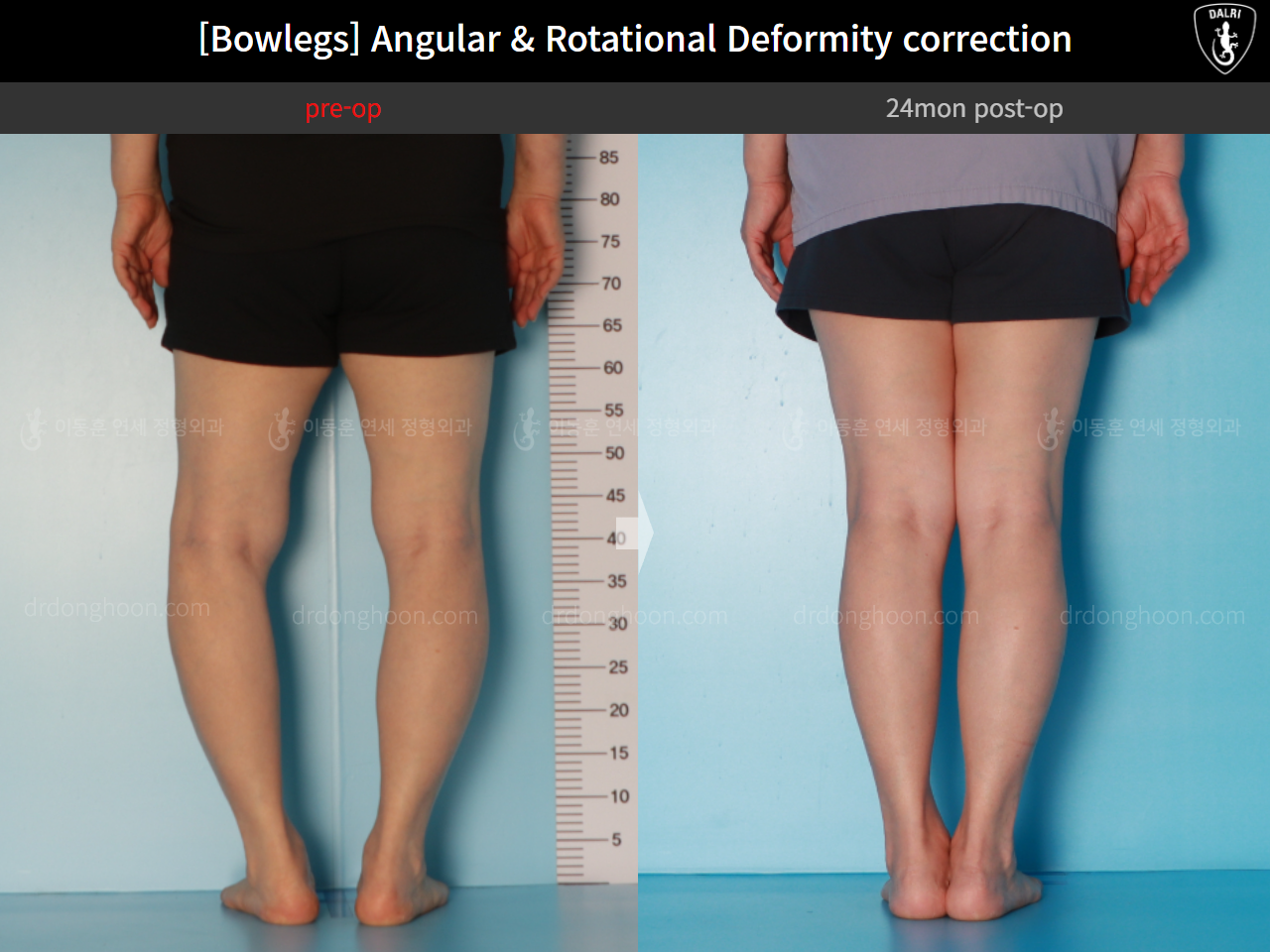 Before and after adult bowlegs, case 16074478, image 6, Dr. Donghoon institute (DALRI)