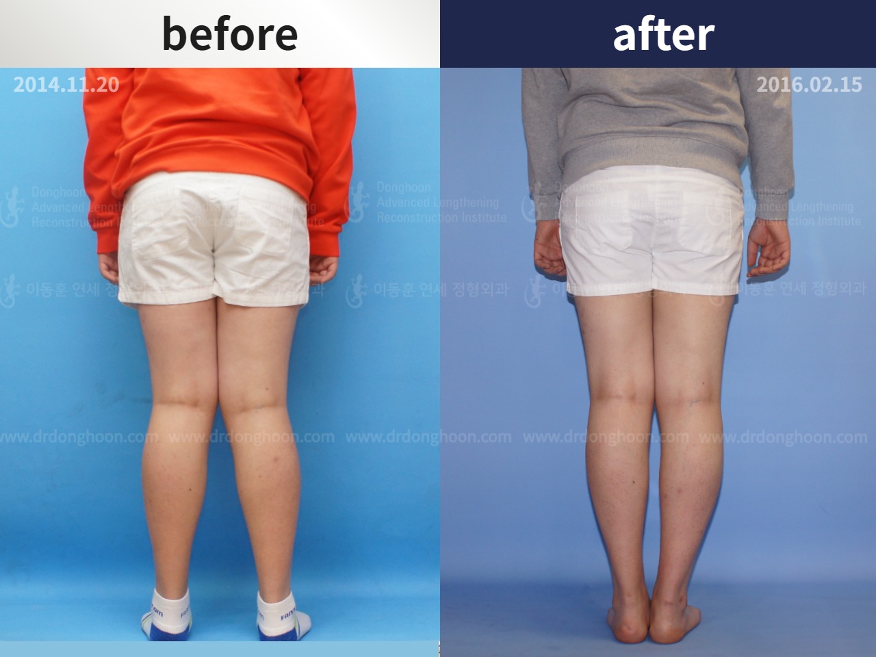 Before and after adult knock knees, case 4586317, image 2, Dr. Donghoon institute (DALRI)