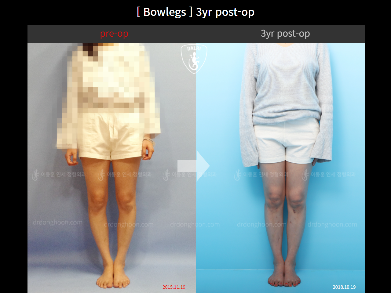 Before and after adult bowlegs, case 4311006, image 1, Dr. Donghoon institute (DALRI)