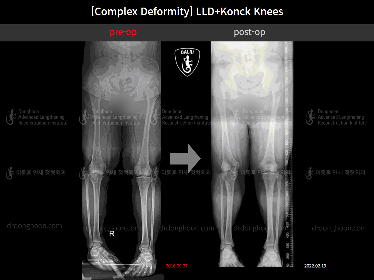 Before and after complex deformity, case 10564251, image 7, Dr. Donghoon institute (DALRI)