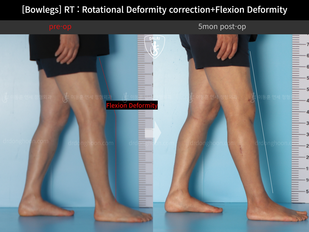 Before and after flexion deformity, case 13668673, image 6, Dr. Donghoon institute (DALRI)