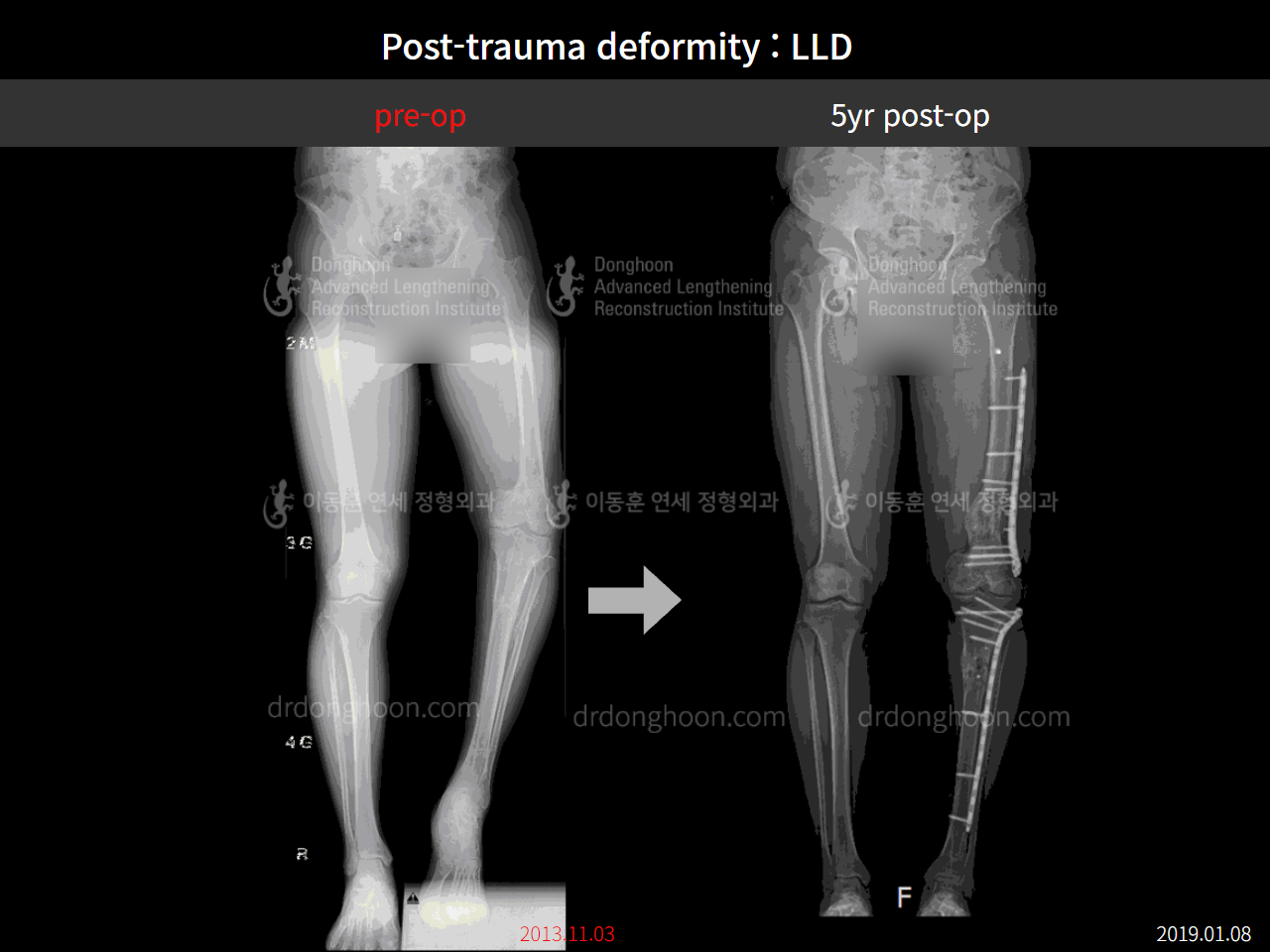 Before and after post-trauma deformity, case 4251806, image 5, Dr. Donghoon institute (DALRI)