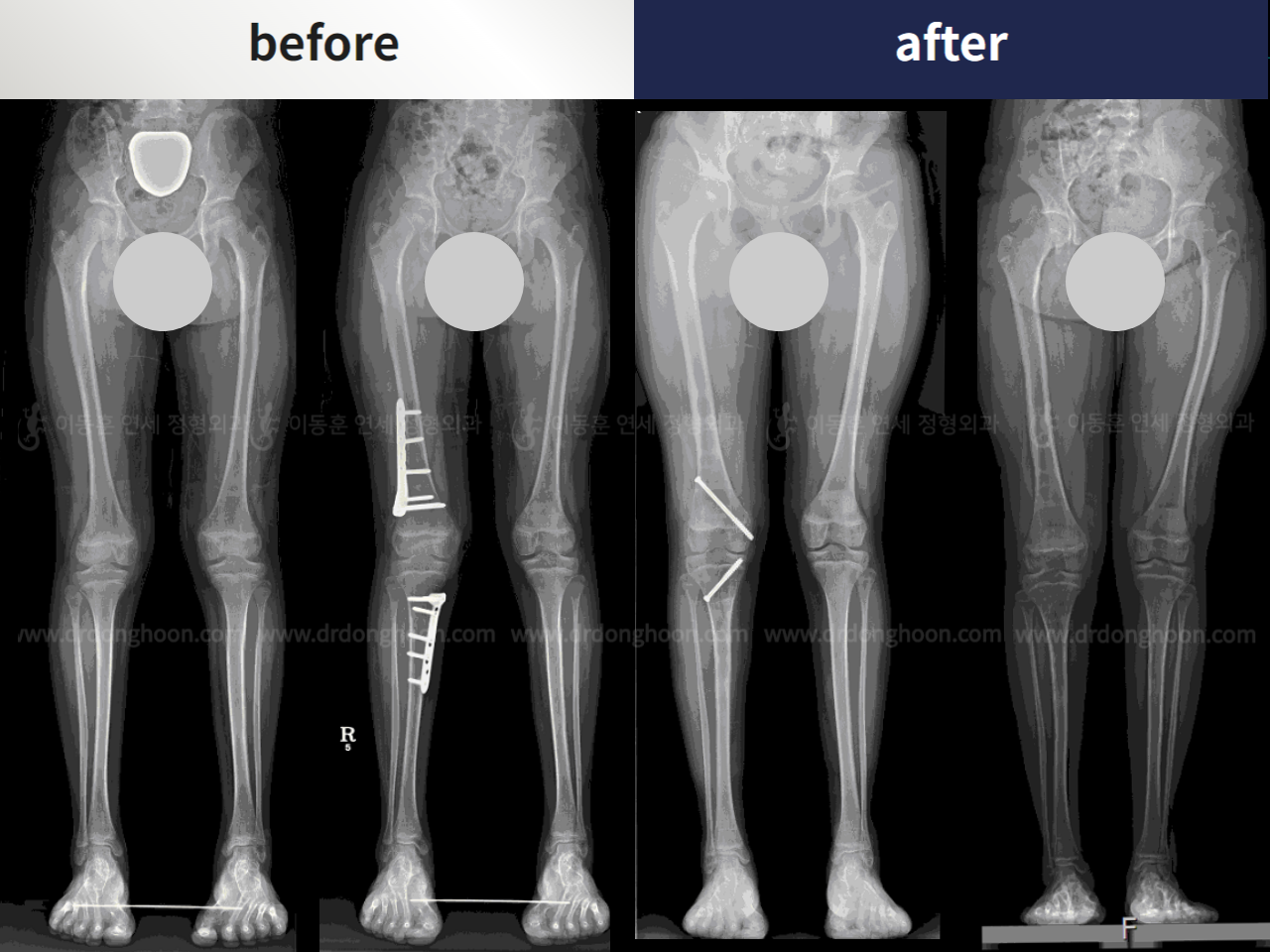 Before and after complex deformity, case 4251599, image 2, Dr. Donghoon institute (DALRI)