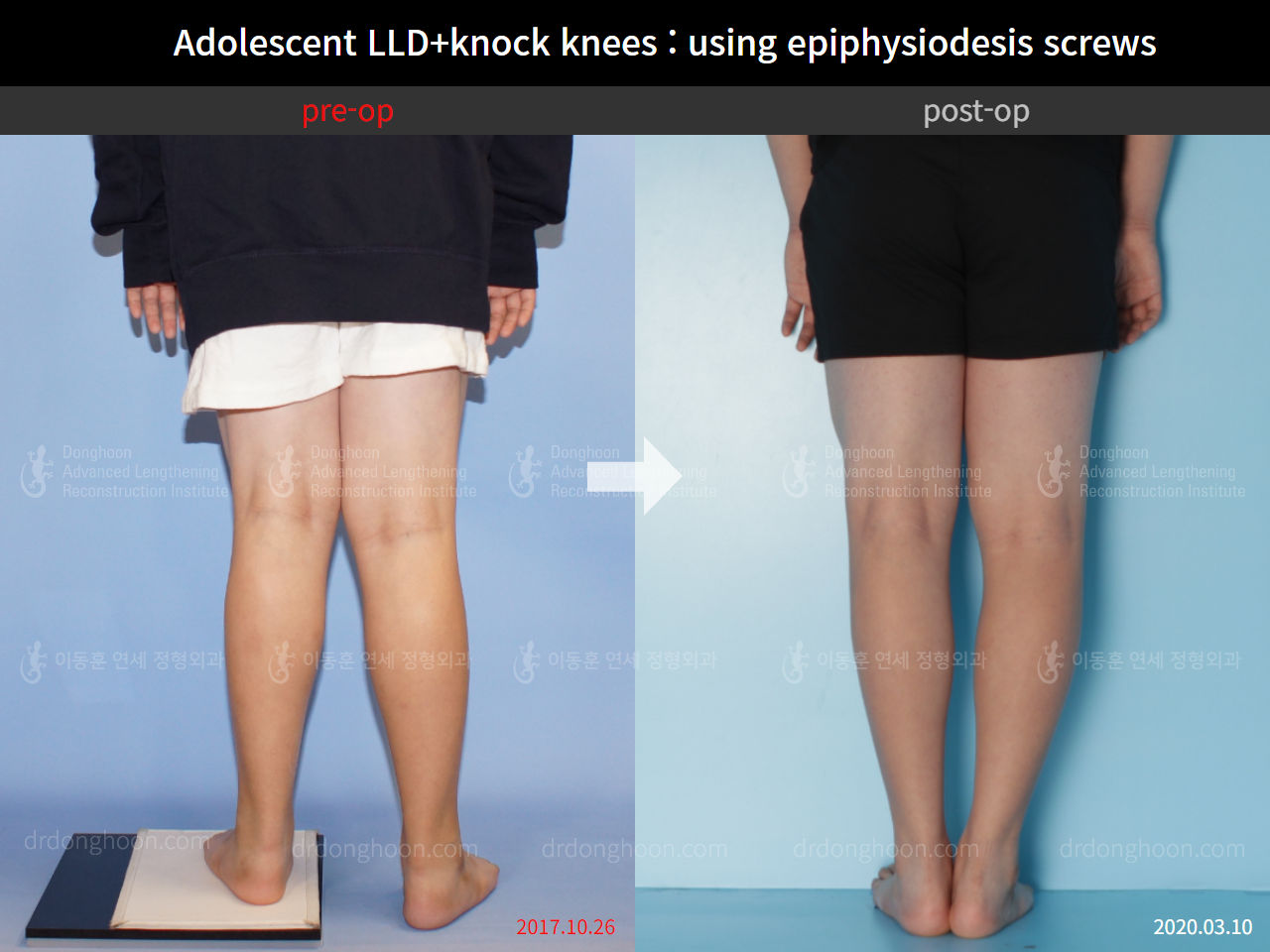 Before and after complex deformity, case 8835405, image 2, Dr. Donghoon institute (DALRI)