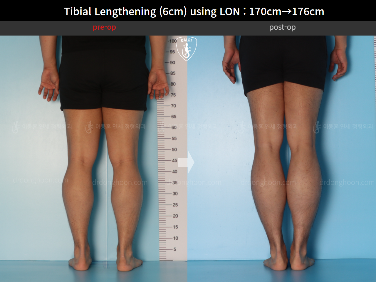Before and after cll lon, case 15623962, image 7, Dr. Donghoon institute (DALRI)
