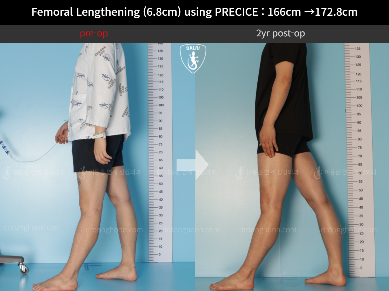Before and after cll precice, case 10883099, image 3, Dr. Donghoon institute (DALRI)