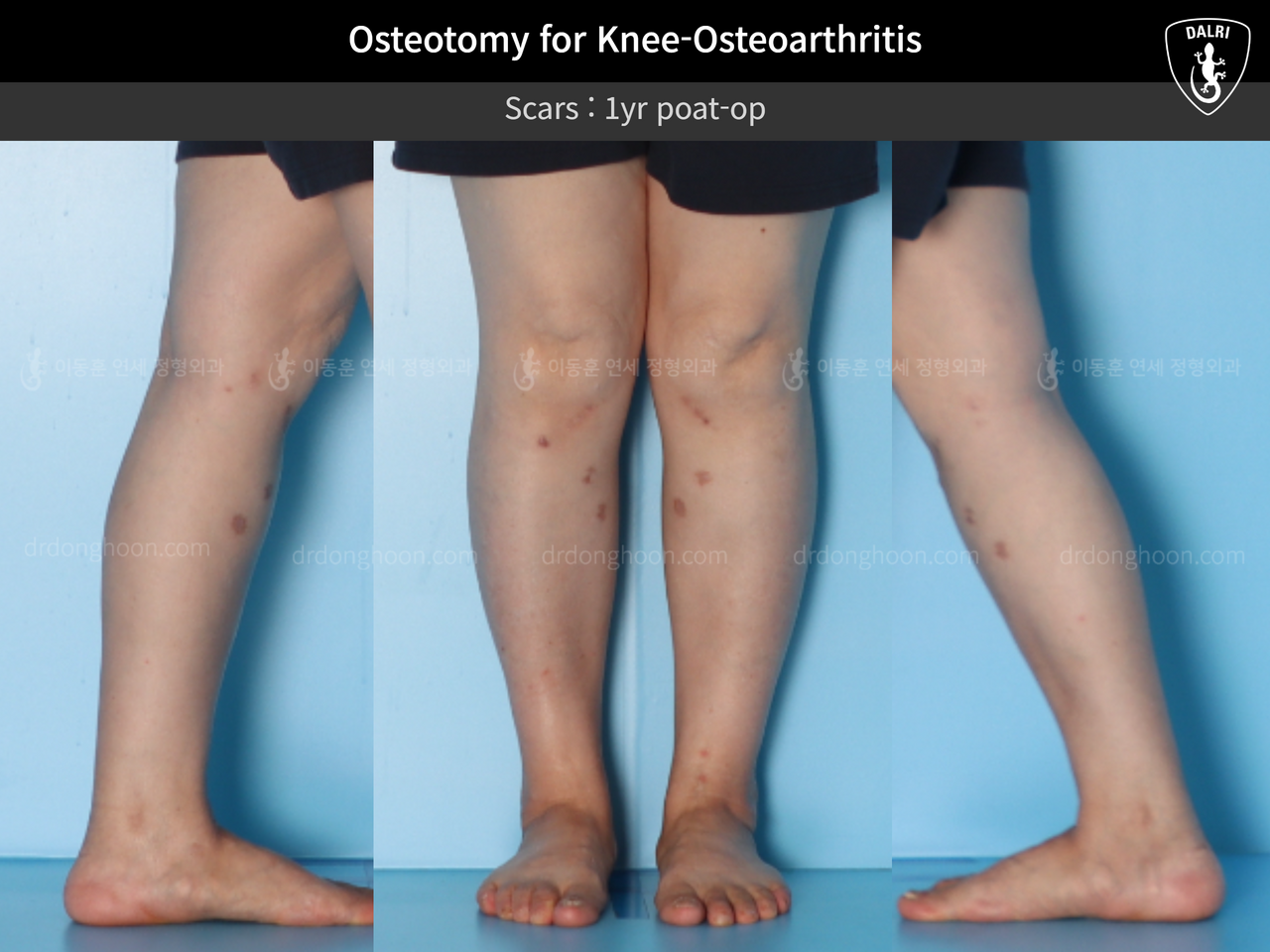 Before and after osteotomy for knee osteoarthritis, case 13231794, image 5, Dr. Donghoon institute (DALRI)