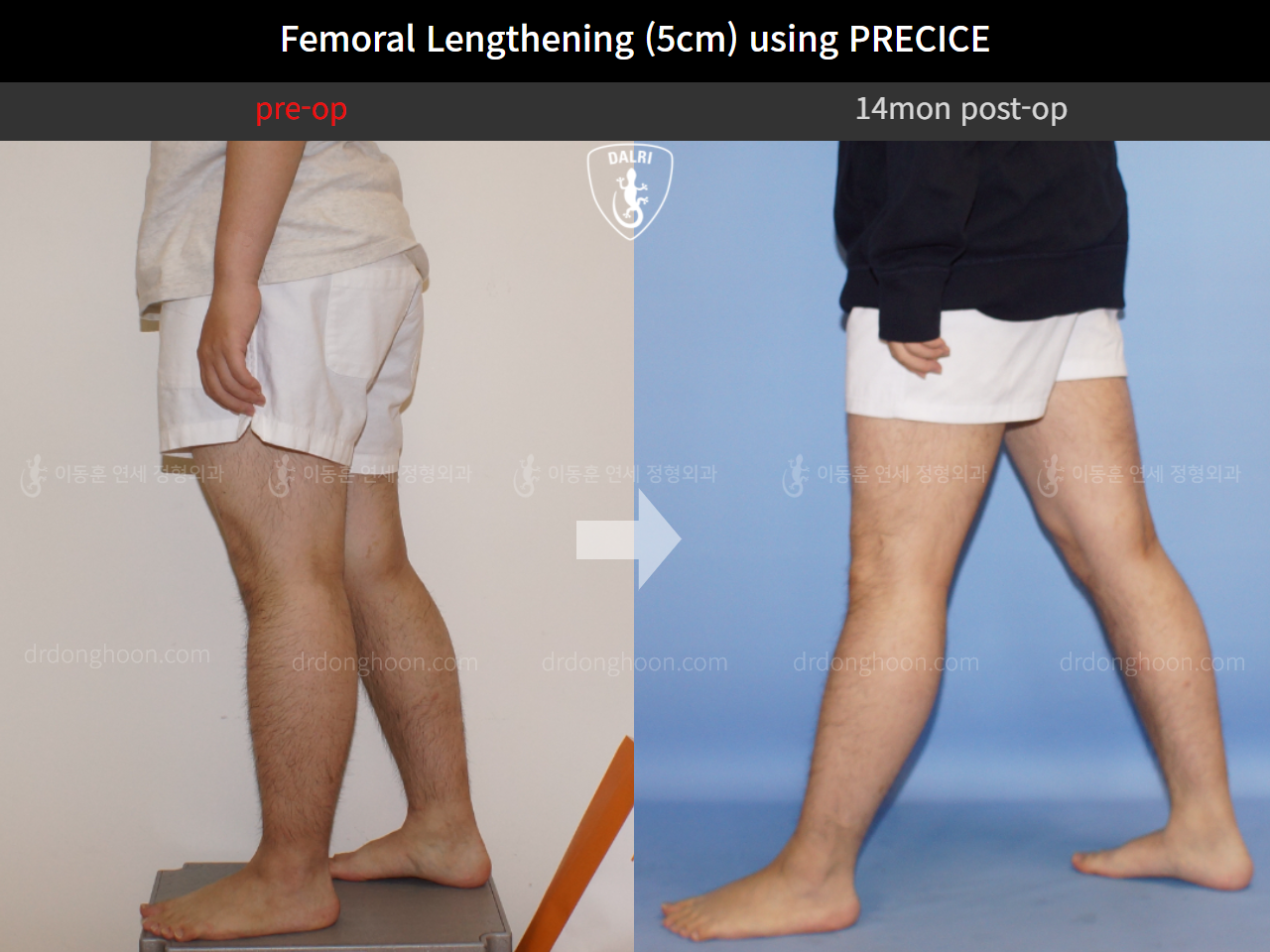 Before and after cll precice, case 4323249, image 8, Dr. Donghoon institute (DALRI)