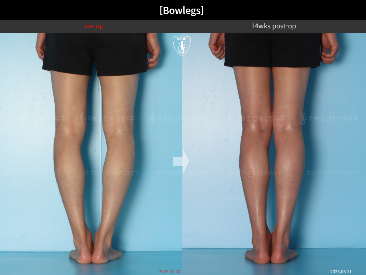 Before and after adult bowlegs, case 15512423, image 9, Dr. Donghoon institute (DALRI)