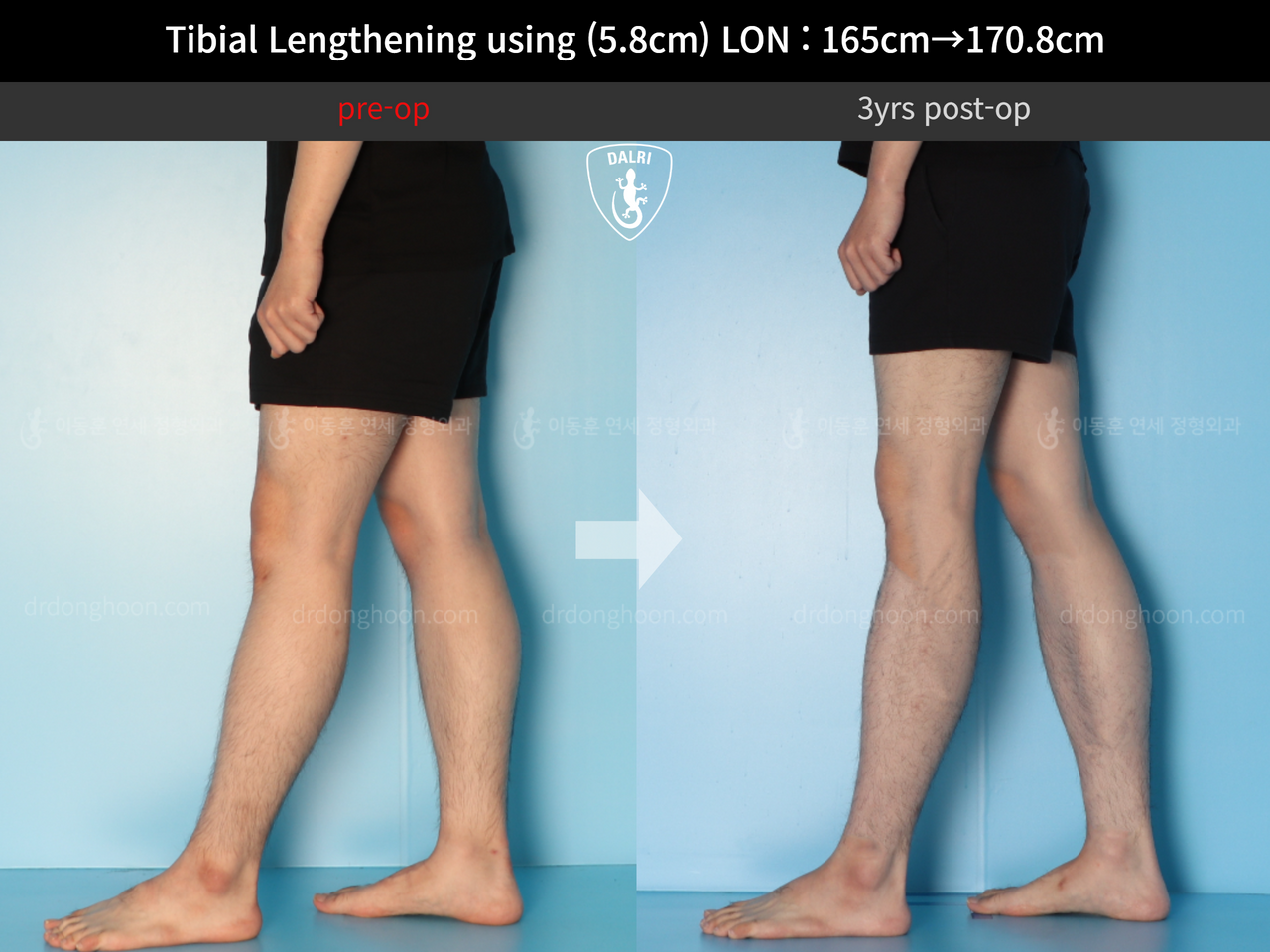 Before and after cll lon, case 12828098, image 6, Dr. Donghoon institute (DALRI)