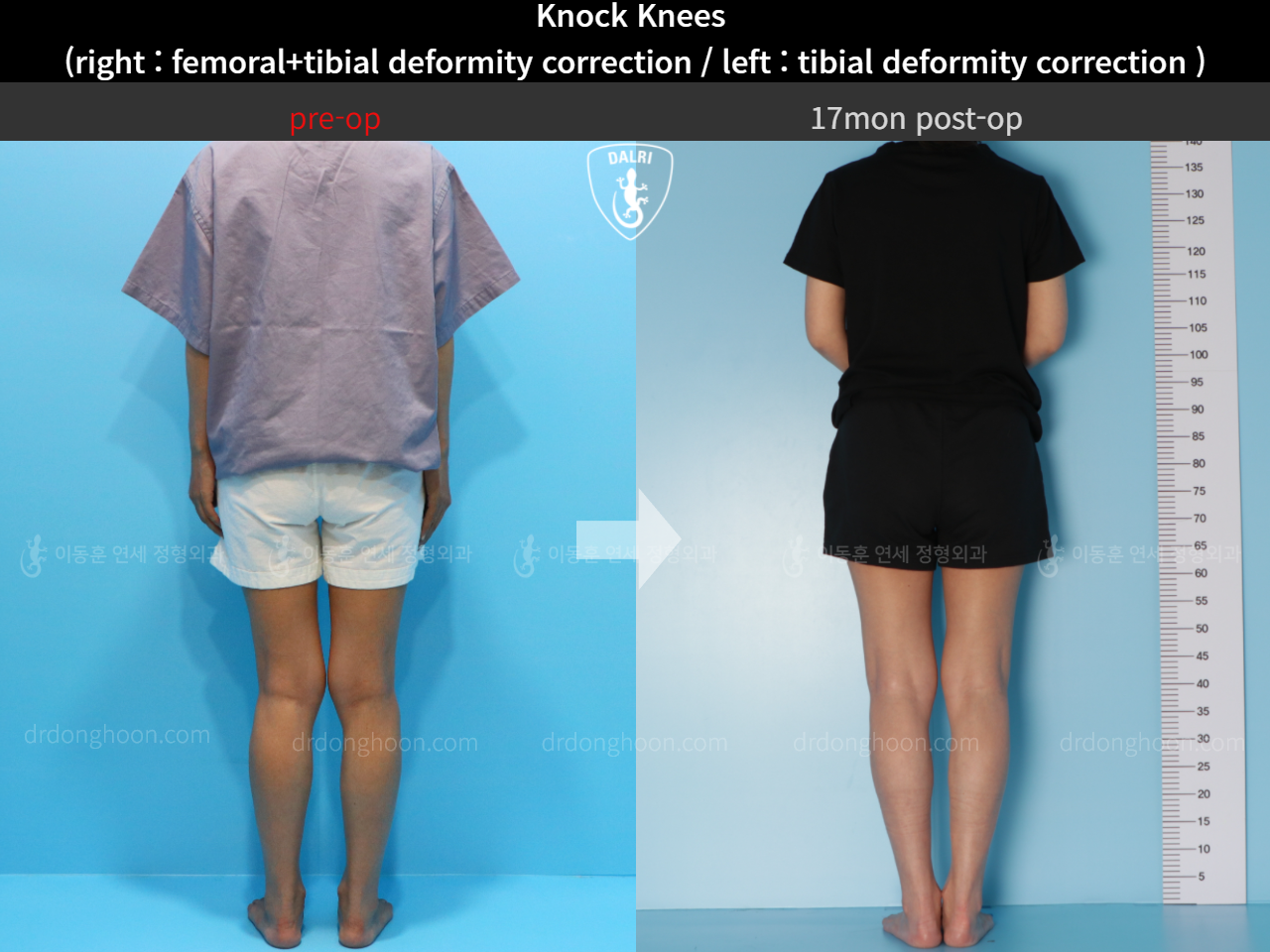 Before and after adult knock knees, case 4640565, image 2, Dr. Donghoon institute (DALRI)