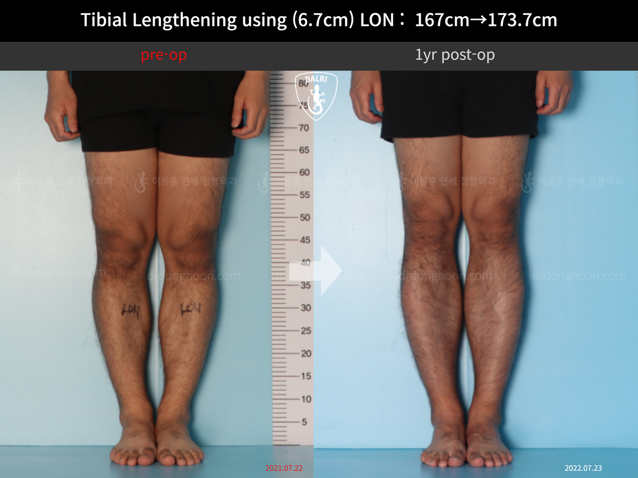 Before and after cll lon, case 12426969, image 5, Dr. Donghoon institute (DALRI)