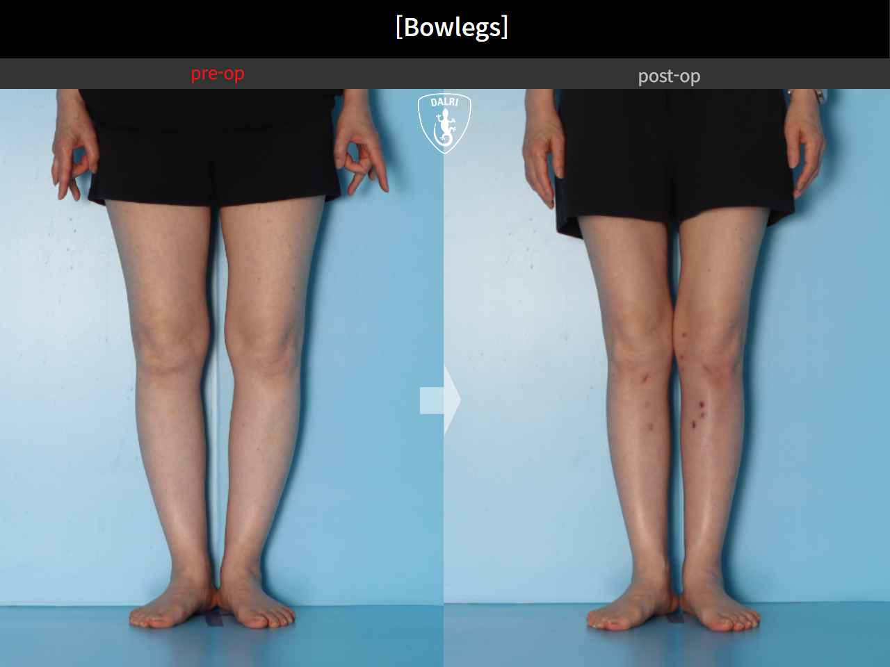 Before and after adult bowlegs, case 30256399, image 9, Dr. Donghoon institute (DALRI)