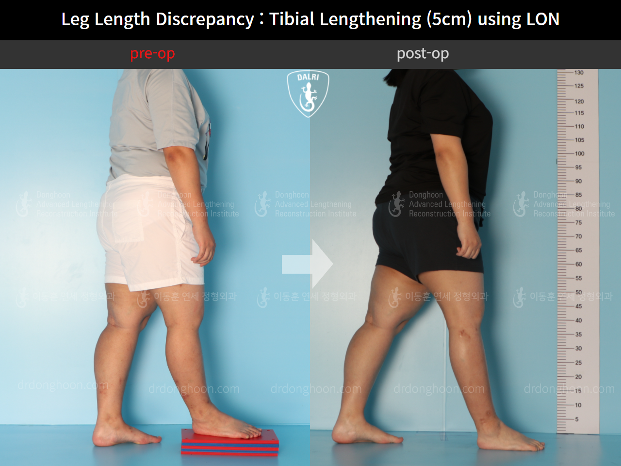 Before and after adult lld, case 9974673, image 3, Dr. Donghoon institute (DALRI)