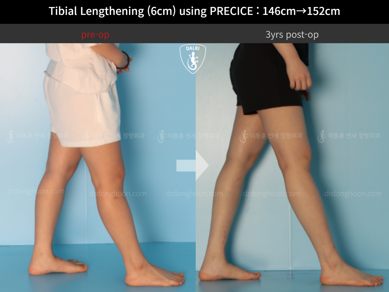 Before and after cll precice, case 4573599, image 8, Dr. Donghoon institute (DALRI)