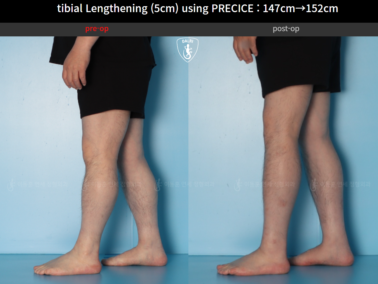 Before and after cll precice, case 89098588, image 9, Dr. Donghoon institute (DALRI)