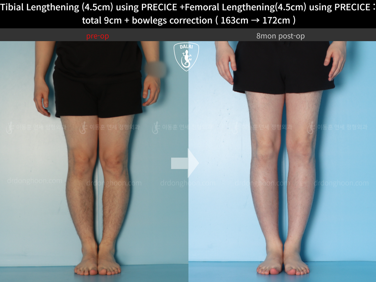 Before and after cll precice, case 13912585, image 9, Dr. Donghoon institute (DALRI)