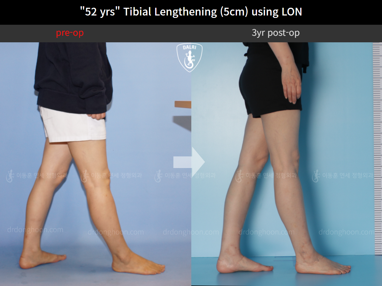 Before and after cll lon, case 9977769, image 8, Dr. Donghoon institute (DALRI)