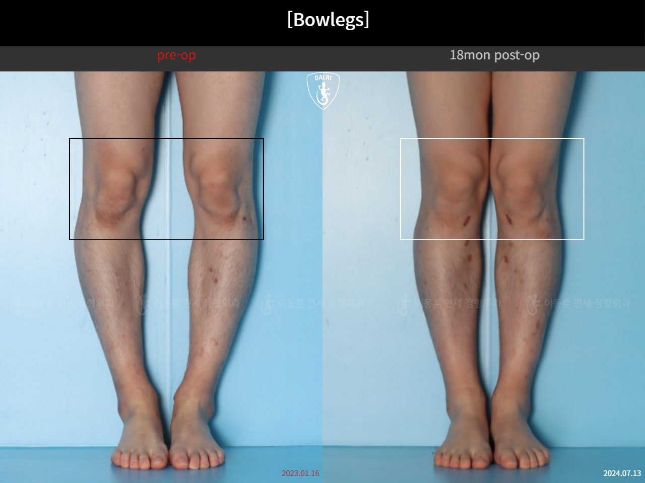 Before and after adult bowlegs, case 124254182, image 6, Dr. Donghoon institute (DALRI)
