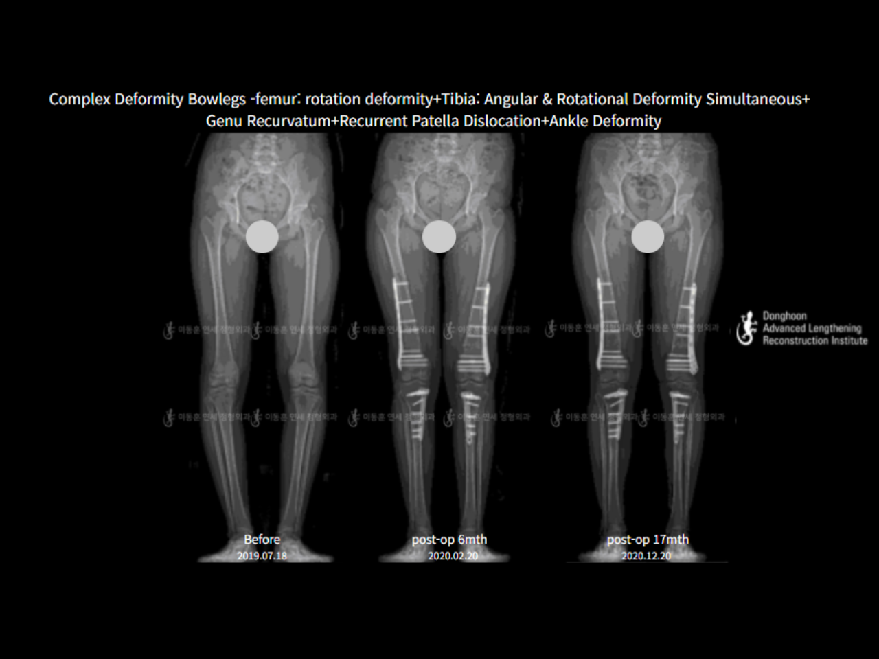 Before and after adult bowlegs, case 6883070, image 9, Dr. Donghoon institute (DALRI)