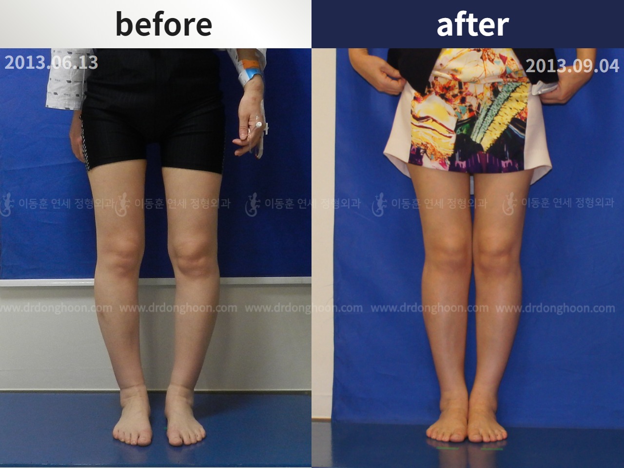 Before and after adult bowlegs, case 4311083, image 1, Dr. Donghoon institute (DALRI)