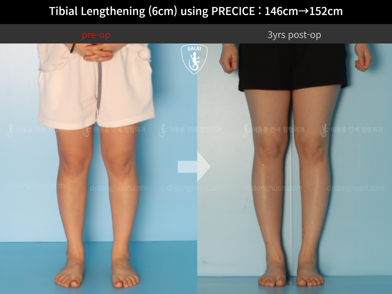 Before and after cll precice, case 4573599, image 5, Dr. Donghoon institute (DALRI)