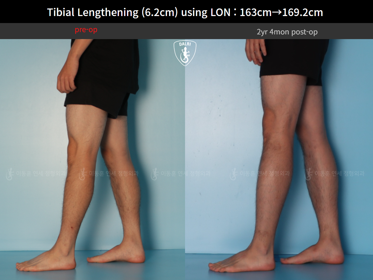 Before and after cll lon, case 128449546, image 10, Dr. Donghoon institute (DALRI)