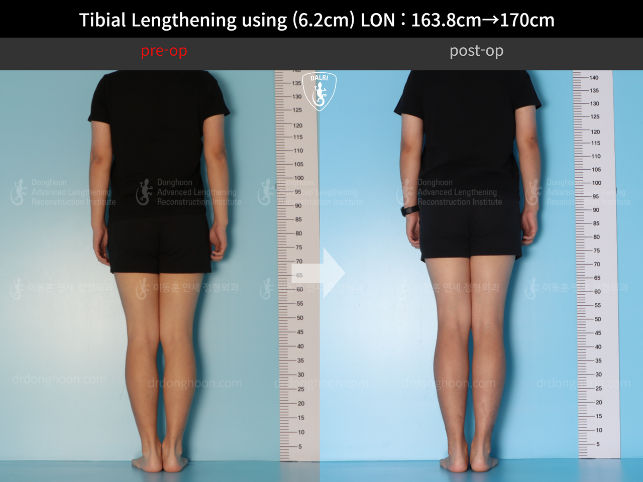 Before and after cll lon, case 13001983, image 2, Dr. Donghoon institute (DALRI)