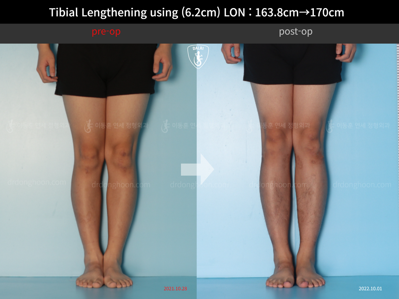 Before and after cll lon, case 13001983, image 5, Dr. Donghoon institute (DALRI)