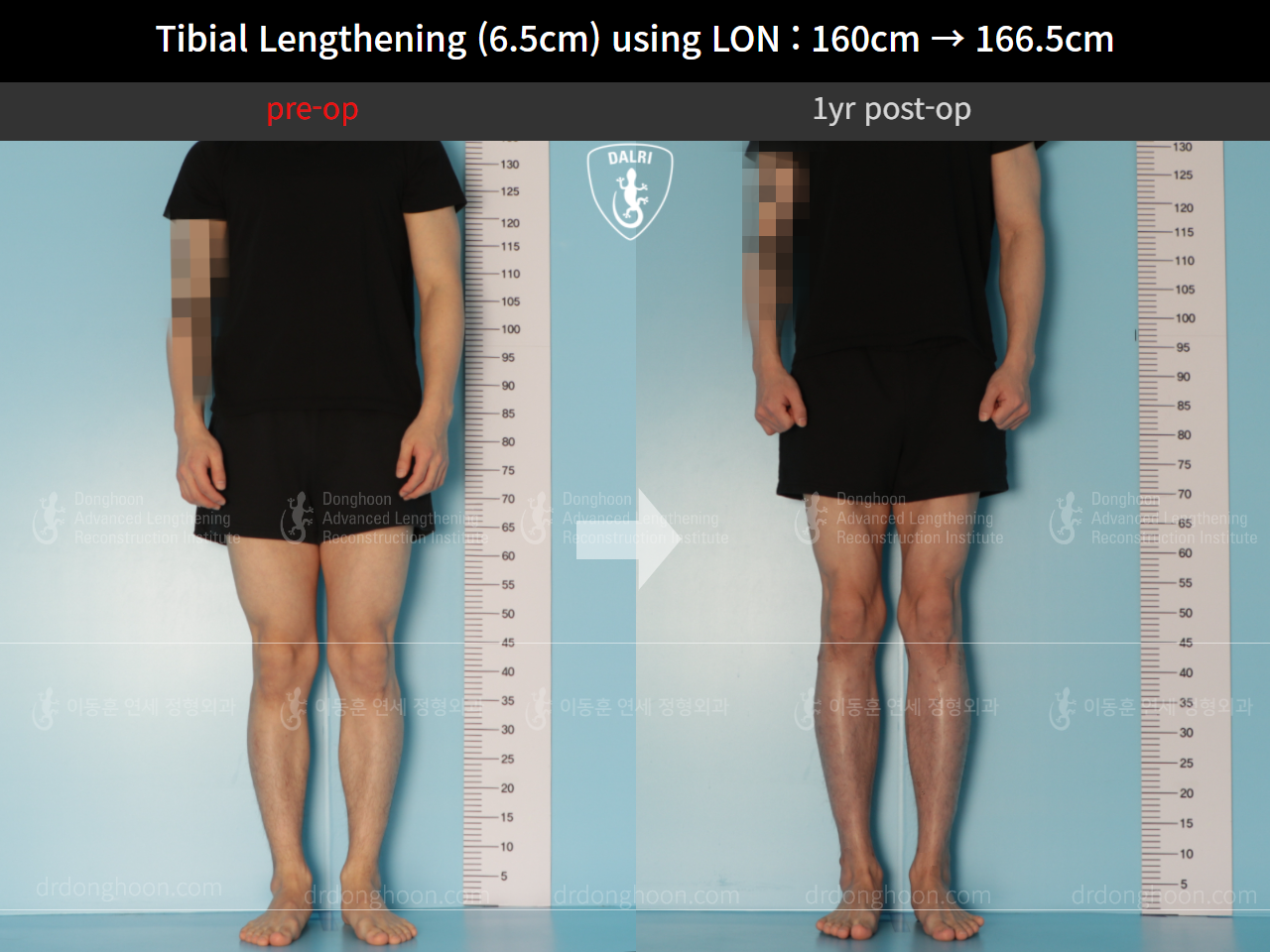 Before and after cll lon, case 10293105, image 1, Dr. Donghoon institute (DALRI)