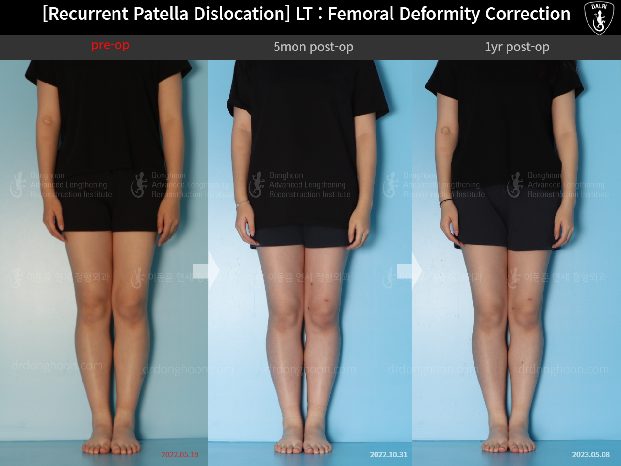 Before and after recurrent patella dislocation, case 15125370, image 1, Dr. Donghoon institute (DALRI)