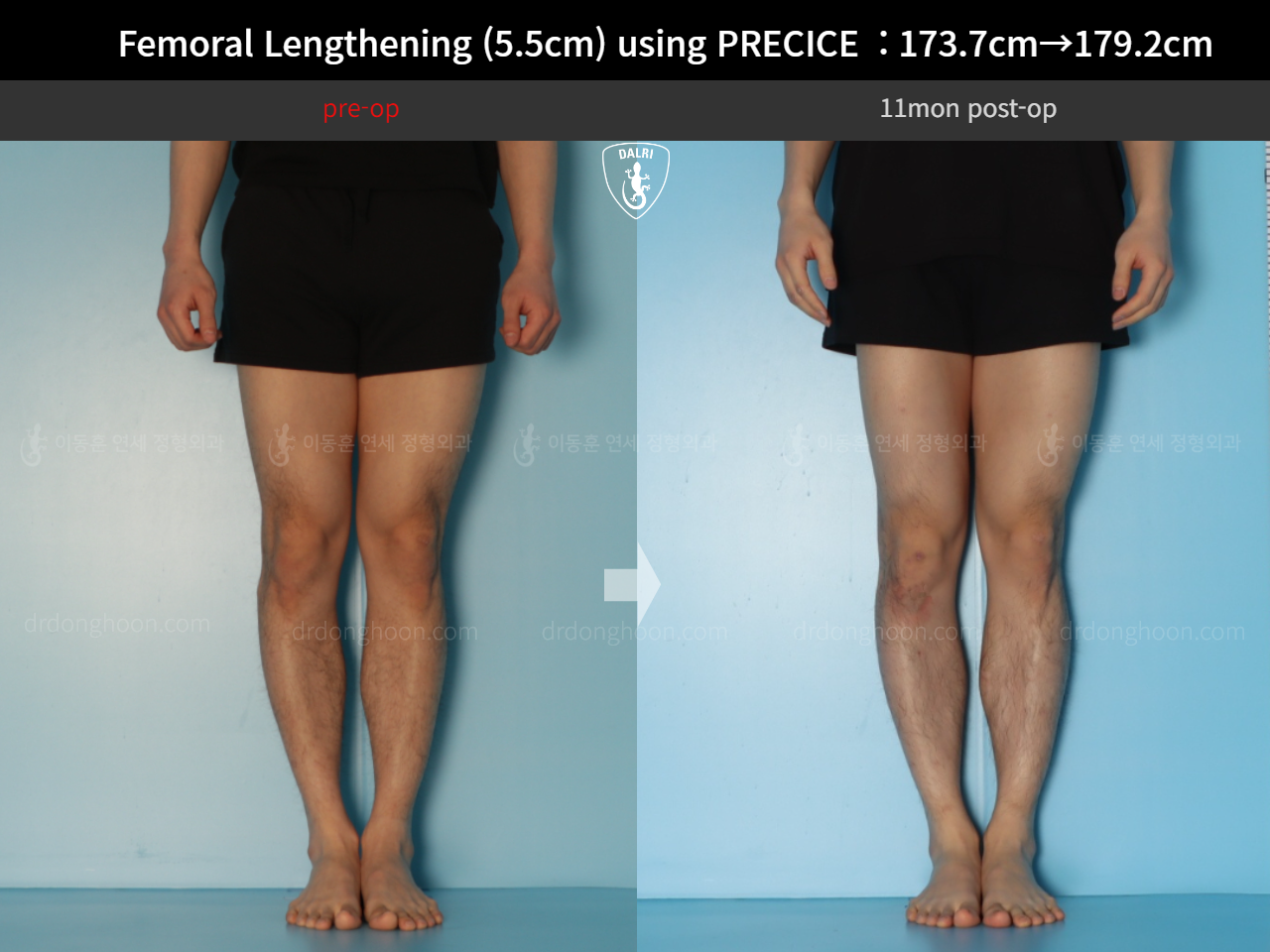 Before and after cll precice, case 18140453, image 8, Dr. Donghoon institute (DALRI)