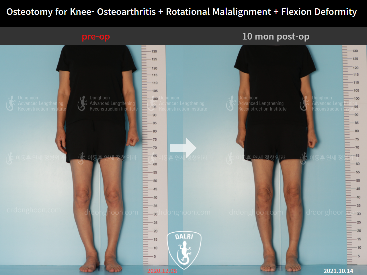 Before and after osteotomy for knee osteoarthritis, case 9128503, image 2, Dr. Donghoon institute (DALRI)