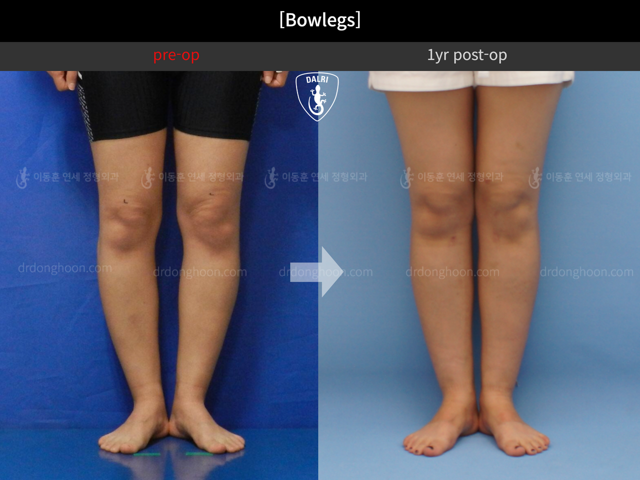 Before and after adult bowlegs, case 12505161, image 4, Dr. Donghoon institute (DALRI)