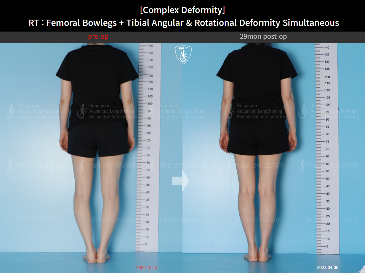 Before and after adult bowlegs, case 14771490, image 4, Dr. Donghoon institute (DALRI)